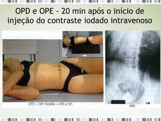 OPD e OPE - 20 min após o início de
injeção do contraste iodado intravenoso
 