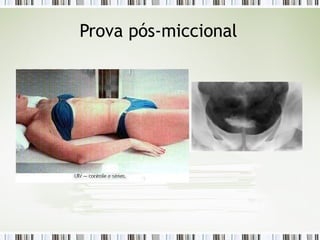 Prova pós-miccional
 