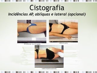 Cistografia
Incidências AP
, oblíquas e lateral (opcional)
 