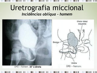 Uretrografia miccional
Incidências oblíqua - homem
 
