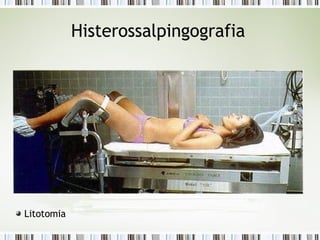 Histerossalpingografia
Litotomia
 