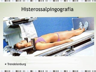 Histerossalpingografia
Trendelenburg
 