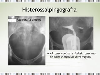 Histerossalpingografia
Radiografia simples
AP com contraste iodado com uso
de pinça e espéculo Intra-vaginal
 