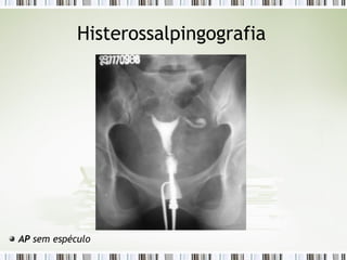 Histerossalpingografia
AP sem espéculo
 