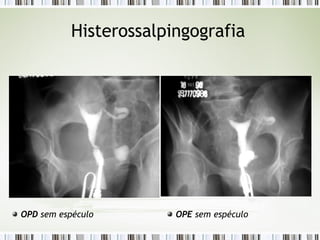 Histerossalpingografia
OPD sem espéculo OPE sem espéculo
 
