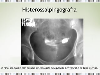 Histerossalpingografia
Final do exame com resíduo de contraste na cavidade peritoneal e na tuba uterina.
 