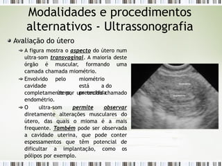 Modalidades e procedimentos
alternativos - Ultrassonografia
Avaliação do útero
A figura mostra o aspecto do útero num
ultra-som transvaginal. A maioria deste
órgão é muscular, formando uma
camada chamada miométrio.
Envolvido
cavidade
pelo miométrio
está a do
útero, preenchida
completamente por um tecido chamado
endométrio.
O ultra-som permite observar
diretamente alterações musculares do
útero, das quais o mioma é a mais
frequente. Também pode ser observada
a cavidade uterina, que pode conter
espessamentos que têm potencial de
dificultar a implantação, como os
pólipos por exemplo.
 