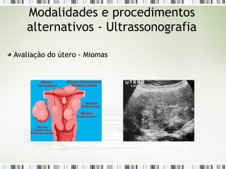 Avaliação do útero - Miomas
Modalidades e procedimentos
alternativos - Ultrassonografia
 