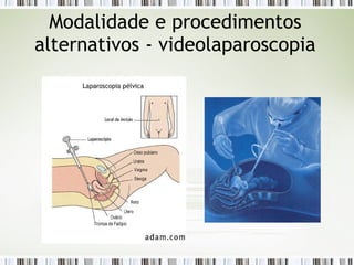 Modalidade e procedimentos
alternativos - videolaparoscopia
 
