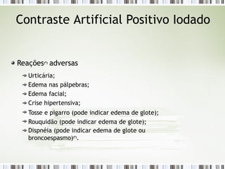 Contraste Artificial Positivo Iodado
Reações(*)
adversas
Urticária;
Edema nas pálpebras;
Edema facial;
Crise hipertensiva;
Tosse e pigarro (pode indicar edema de glote);
Rouquidão (pode indicar edema de glote);
Dispnéia (pode indicar edema de glote ou
broncoespasmo)(*)
.
 