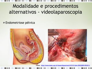 Endometriose pélvica
Modalidade e procedimentos
alternativos - videolaparoscopia
Fonte: http://www.teses.usp.br/teses/disponiveis/5/5151/tde-25032009-093011/
 