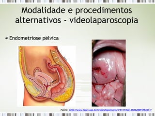 Endometriose pélvica
Modalidade e procedimentos
alternativos - videolaparoscopia
Fonte: http://www.teses.usp.br/teses/disponiveis/5/5151/tde-25032009-093011/
 