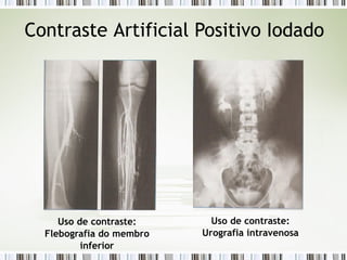Contraste Artificial Positivo Iodado
Uso de contraste:
Flebografia do membro
inferior
Uso de contraste:
Urografia intravenosa
 