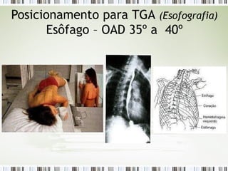 Posicionamento para TGA (Esofografia)
Esôfago – OAD 35º a 40º
 