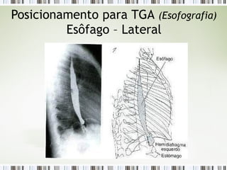 Posicionamento para TGA (Esofografia)
Esôfago – Lateral
 