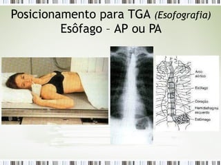 Posicionamento para TGA (Esofografia)
Esôfago – AP ou PA
 