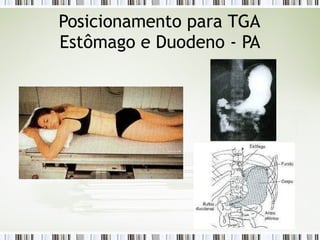 Posicionamento para TGA
Estômago e Duodeno - PA
 