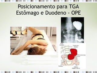Posicionamento para TGA
Estômago e Duodeno - OPE
 