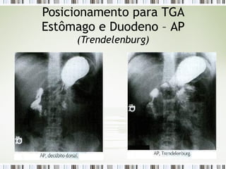 Posicionamento para TGA
Estômago e Duodeno – AP
(Trendelenburg)
 