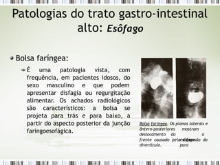 Patologias do trato gastro-intestinal
alto: Esôfago
Bolsa faríngea:
É uma patologia vista, com
frequência, em pacientes idosos, do
sexo masculino e que podem
apresentar disfagia ou regurgitação
alimentar. Os achados radiológicos
são característicos: a bolsa se
projeta para trás e para baixo, a
partir do aspecto posterior da junção
faringoesofágica.
Bolsa faríngea. Os planos laterais e
ântero-posteriores
deslocamento do
mostram
o
esôfago
para
frente causado pela expansão do
divertículo.
 