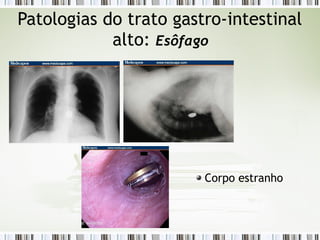Patologias do trato gastro-intestinal
alto: Esôfago
Corpo estranho
 