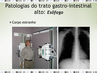 Patologias do trato gastro-intestinal
alto: Esôfago
Corpo estranho
 