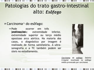Patologias do trato gastro-intestinal
alto: Esôfago
Carcinoma(*)
do esôfago:
Pode ocorrer em três
localizações
preferenciais: extremidade
extremidade superior ou terço
inferior,
médio
opostoao arco aórtico. Na maioria dos
casos, o diagnóstico por imagem é
realizado de forma satisfatória. A ultra-
sonografia e a TC também podem ser
úteis no estadiamento.
irregular localizado no
Carcinoma do esôfago. Defeito
esôfago
médio provocado por carcinoma
 