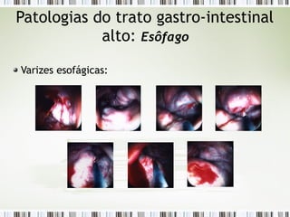 Patologias do trato gastro-intestinal
alto: Esôfago
Varizes esofágicas:
 