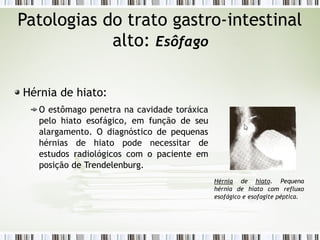 Patologias do trato gastro-intestinal
alto: Esôfago
Hérnia de hiato:
O estômago penetra na cavidade toráxica
pelo hiato esofágico, em função de seu
alargamento. O diagnóstico de pequenas
hérnias de hiato pode necessitar de
estudos radiológicos com o paciente em
posição de Trendelenburg.
Hérnia de hiato. Pequena
hérnia de hiato com refluxo
esofágico e esofagite péptica.
 