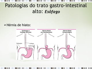 Patologias do trato gastro-intestinal
alto: Esôfago
Hérnia de hiato:
 