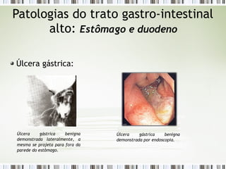 Patologias do trato gastro-intestinal
alto: Estômago e duodeno
Úlcera gástrica:
Úlcera gástrica benigna
demonstrada lateralmente, a
mesma se projeta para fora da
parede do estômago.
Úlcera gástrica benigna
demonstrada por endoscopia.
 