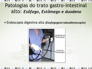 Patologias do trato gastro-intestinal
alto: Esôfago, Estômago e duodeno
Endoscopia digestiva alta (Esofagogastroduodenoscopia)
 
