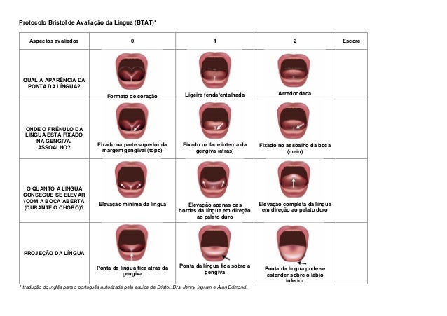 Anquiloglossia Teste Da Linguinha Nota Tecnica Do Ministerio Da Sa