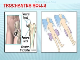 TROCHANTER ROLLS
Mrs. Babitha K Devu, Asstt. Professor
 