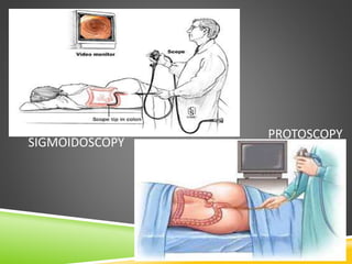 SIGMOIDOSCOPY
PROTOSCOPY
 