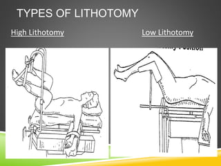 TYPES OF LITHOTOMY
High Lithotomy Low Lithotomy
 