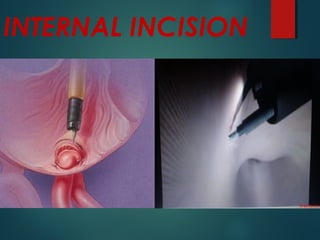 INTERNAL INCISION
 