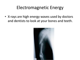 Electromagnetic Energy
• X-rays are high energy waves used by doctors
  and dentists to look at your bones and teeth.
 