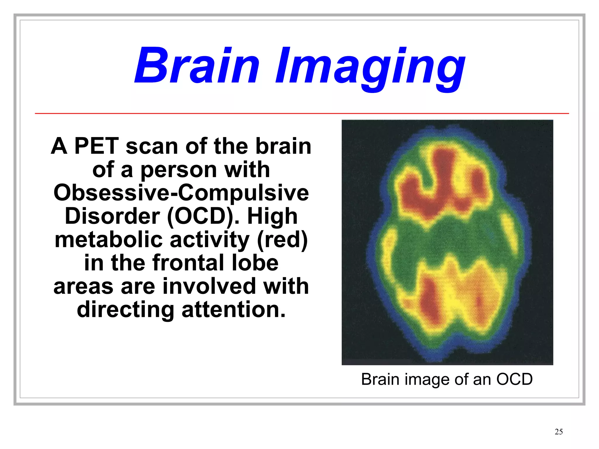 Brain Imaging A PET scan of the brain of a person with Obsessive-Compulsive Disorder (OCD). High metabolic activity (red) in the frontal lobe areas are involved with directing attention. Brain image of an OCD 