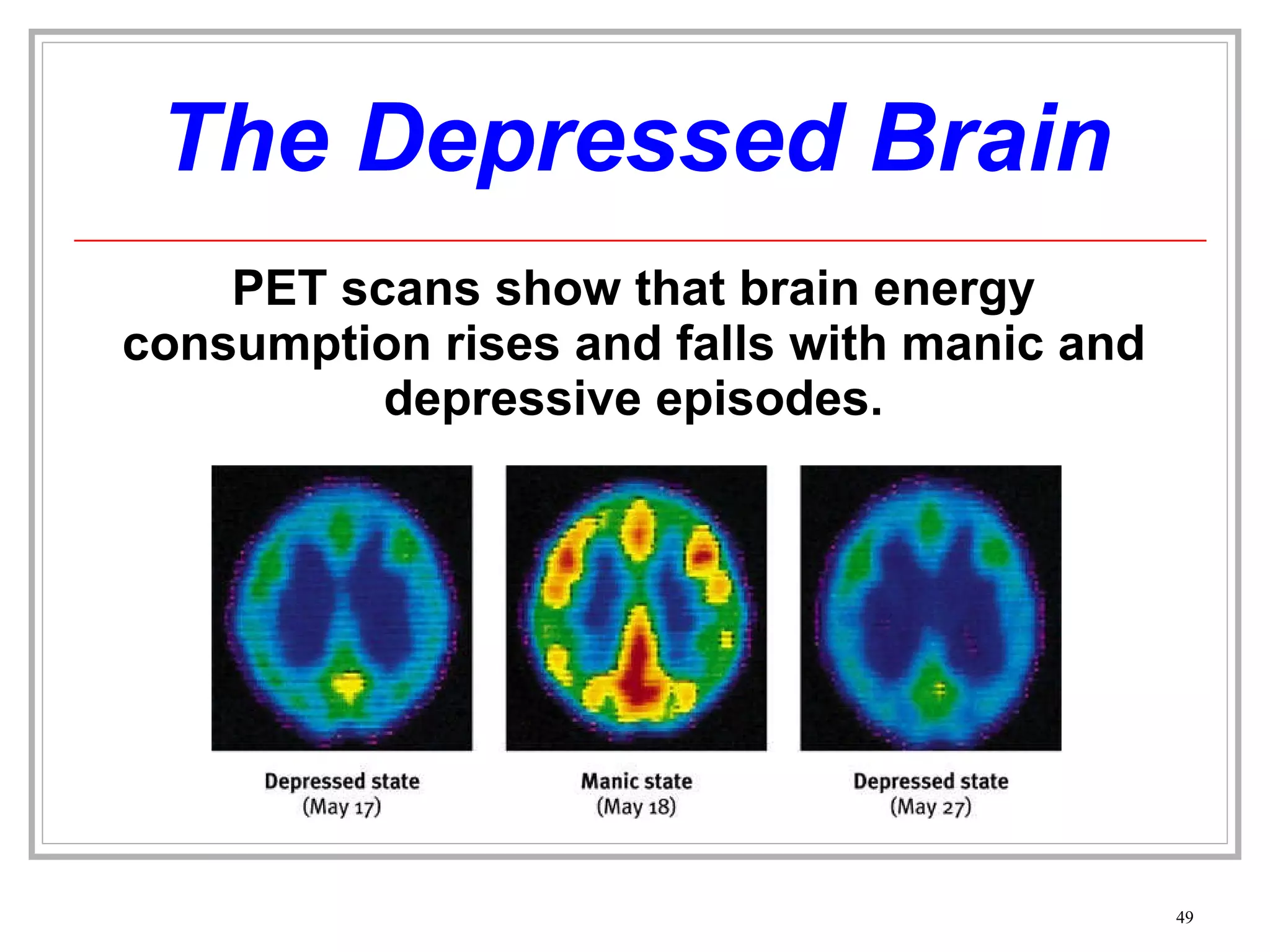 The Depressed Brain PET scans show that brain energy consumption rises and falls with manic and depressive episodes. 