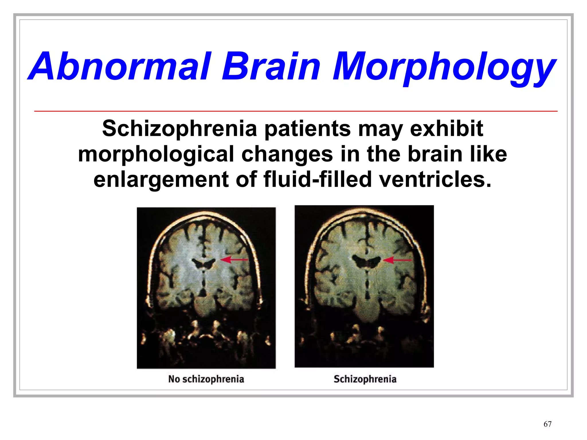 Abnormal Brain Morphology Schizophrenia patients may exhibit morphological changes in the brain like enlargement of fluid-filled ventricles. 