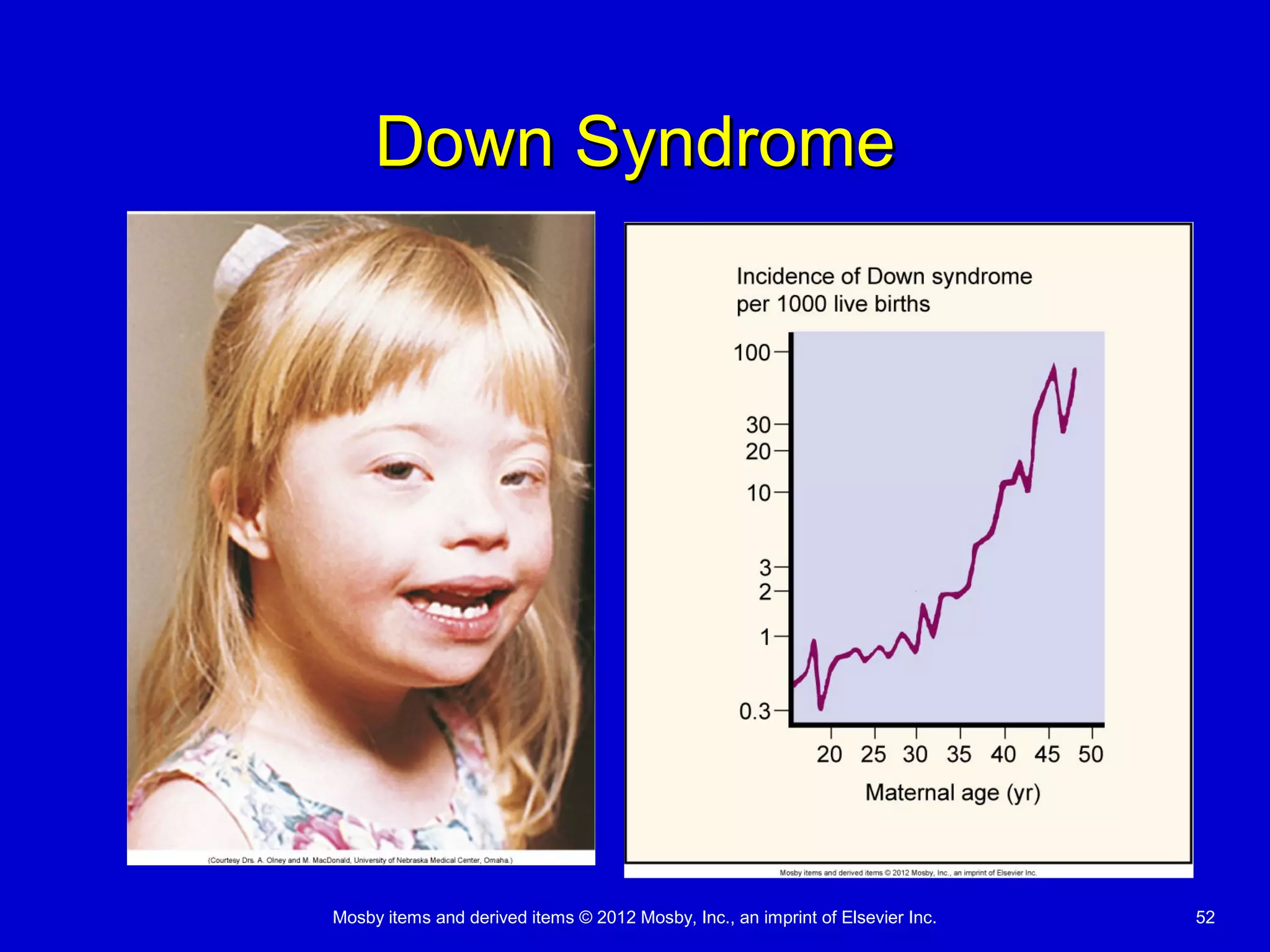 Mosby items and derived items © 2012 Mosby, Inc., an imprint of Elsevier Inc. 52
Down SyndromeDown Syndrome
 