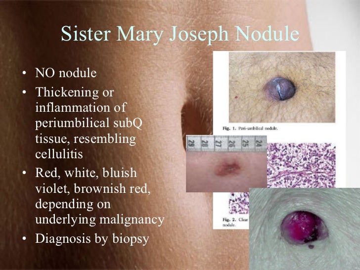 Belly Buttons Not Just About Innies, Outies, Or Piercings