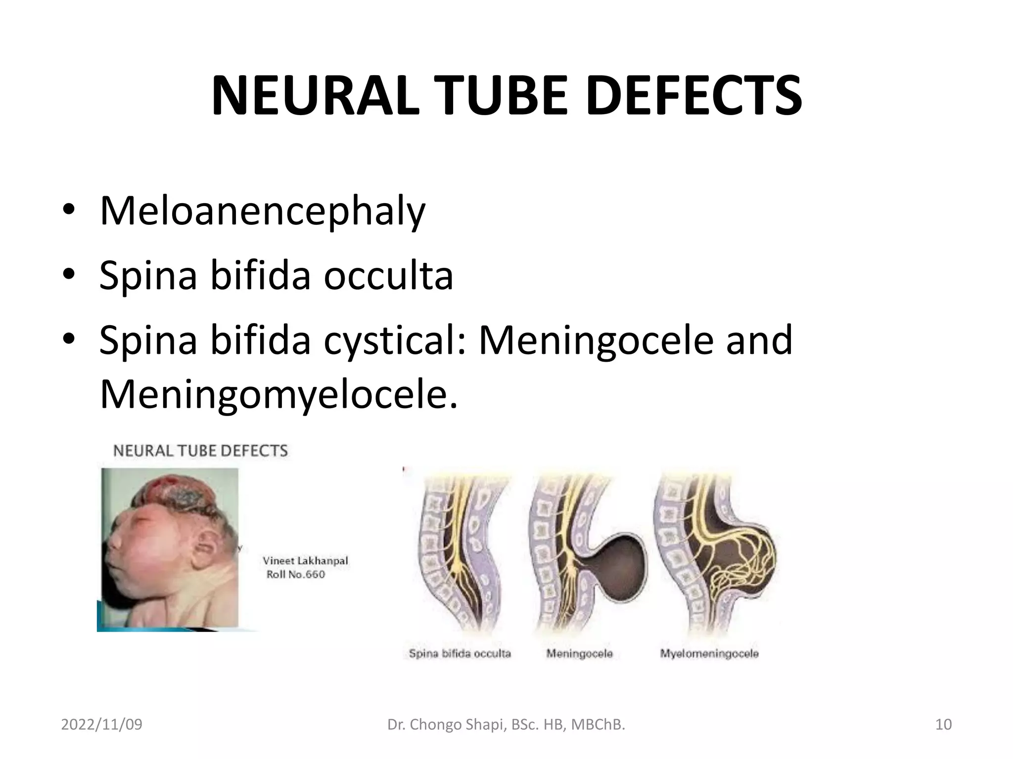 NEURAL TUBE DEFECTS
• Meloanencephaly
• Spina bifida occulta
• Spina bifida cystical: Meningocele and
Meningomyelocele.
2022/11/09 Dr. Chongo Shapi, BSc. HB, MBChB. 10
 