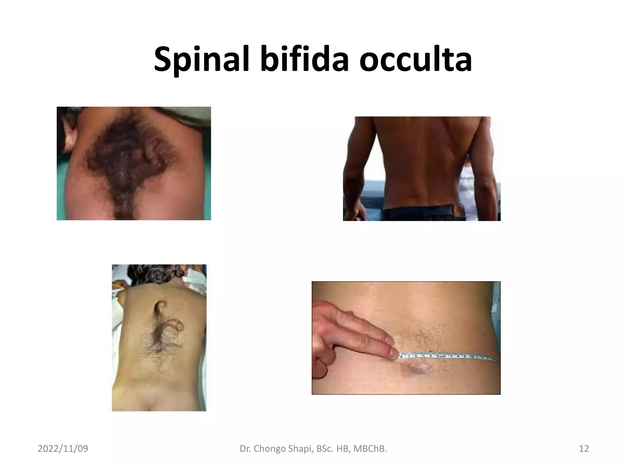 Spinal bifida occulta
2022/11/09 Dr. Chongo Shapi, BSc. HB, MBChB. 12
 