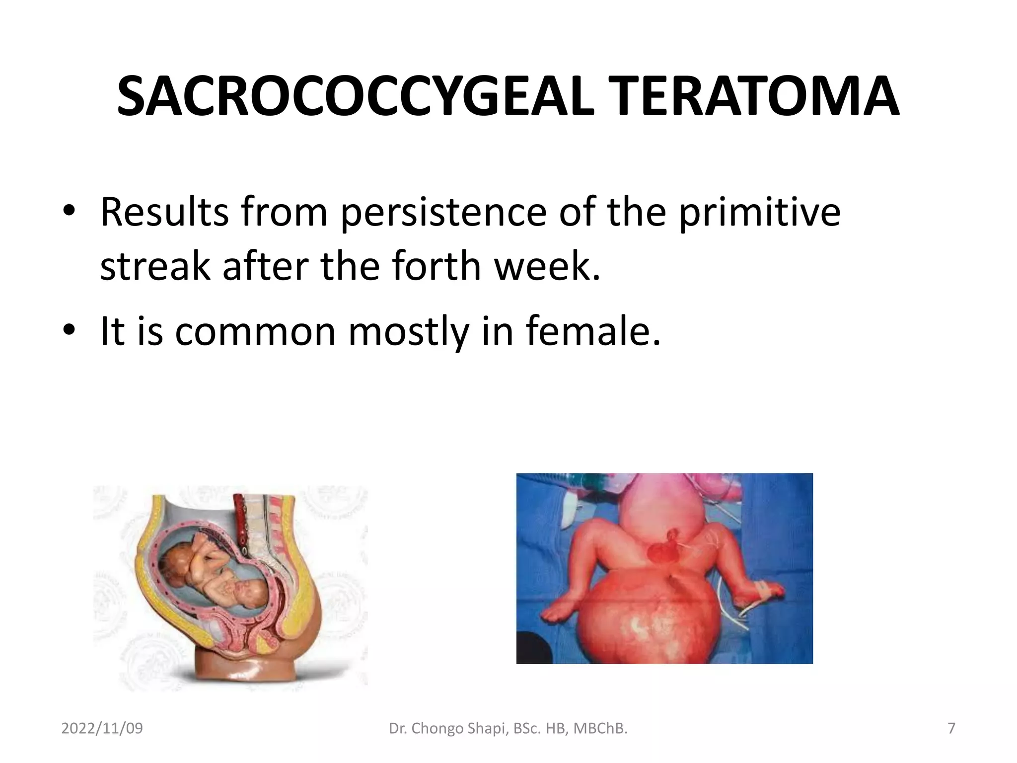 SACROCOCCYGEAL TERATOMA
• Results from persistence of the primitive
streak after the forth week.
• It is common mostly in female.
2022/11/09 Dr. Chongo Shapi, BSc. HB, MBChB. 7
 