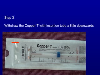 Step 3

Withdraw the Copper T with insertion tube a little downwards
 
