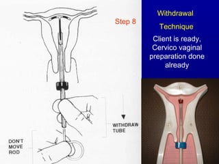 Withdrawal
Step 8
            Technique
          Client is ready,
          Cervico vaginal
         preparation done
              already
 