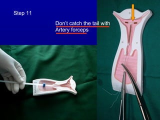 Step 11
          Don’t catch the tail with
          Artery forceps
 
