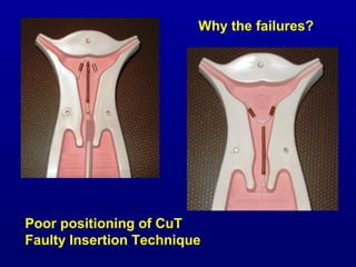 Why the failures?




Poor positioning of CuT
Faulty Insertion Technique
 